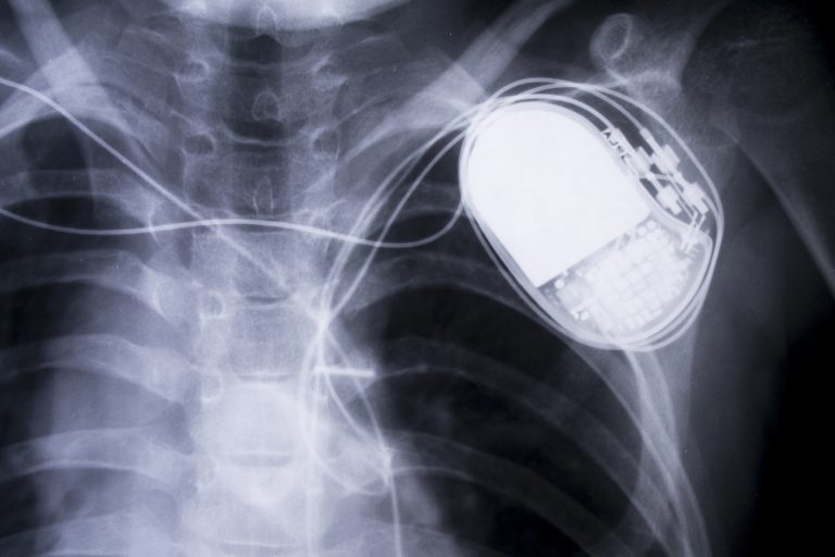 pacemaker