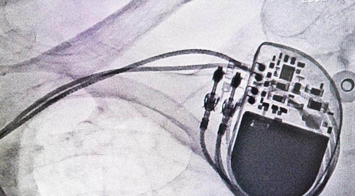 IoT Medical Device Fatal Flaw? Hackers Demonstrate New Attacks pacemaker hack